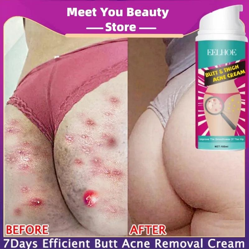Booty Bliss Acne Clearing Cream - Butt and Thigh Skin Revitalizer  ourlum.com   