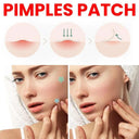 Clear Complexion Star Acne Healing Stickers - 200pcs Colorful Pimple Patches for Blemish-Free Skin  ourlum.com   