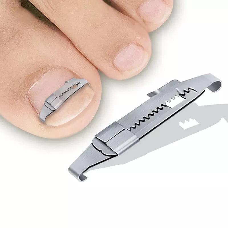 Ingrown Toenail Corrector Kit: Professional Foot Care Solution