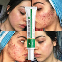 Acne Control Cream: Herbal Whitening and Moisturizing Solution