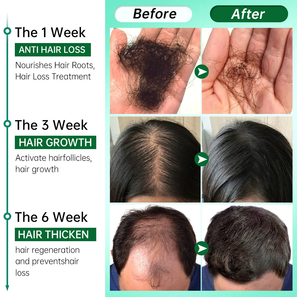 Rosemary Ginger Coconut Oil Hair Growth Solution for Hair Loss & Scalp Care  ourlum.com   