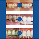 Brightest Smile Dental Care Complete Whitening Solution