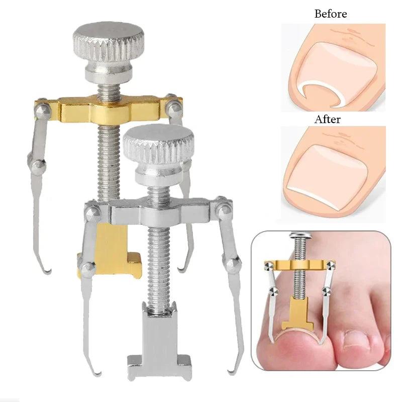 Ingrown Toenail Corrector - Professional Foot Care Tool