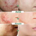 Herbal Acne Treatment Cream for Clear Skin and Pore Purification