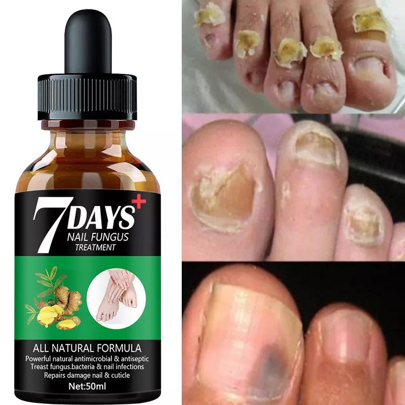 7DAYS Nail Fungus Treatment Essence Serum Care Hand and Foot Care Removal Repair Gel Anti-infective  ourlum.com   