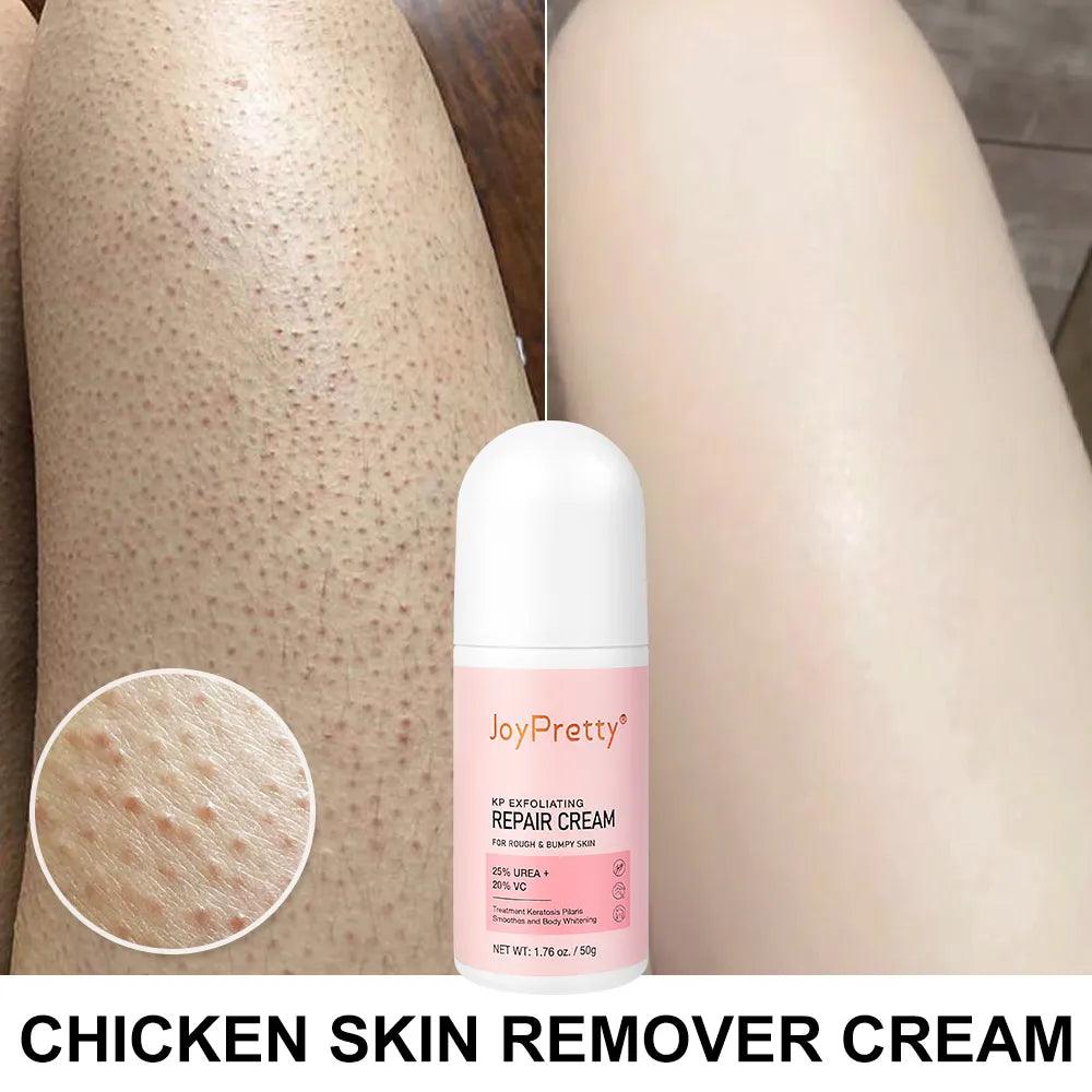 Body Cream Chicken Skin Removal Treatment Keratosis Pilaris Lotion Rough Bumpy Pore Spots Care Moisturizer Whitening Creams 60g  ourlum.com United State  