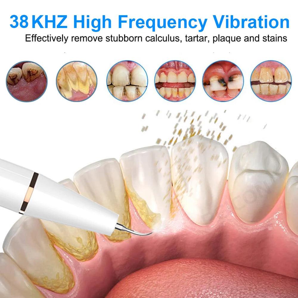 Ultrasonic Teeth Stain Remover with Sonic Power and Gentle Stone Removal  ourlum.com   
