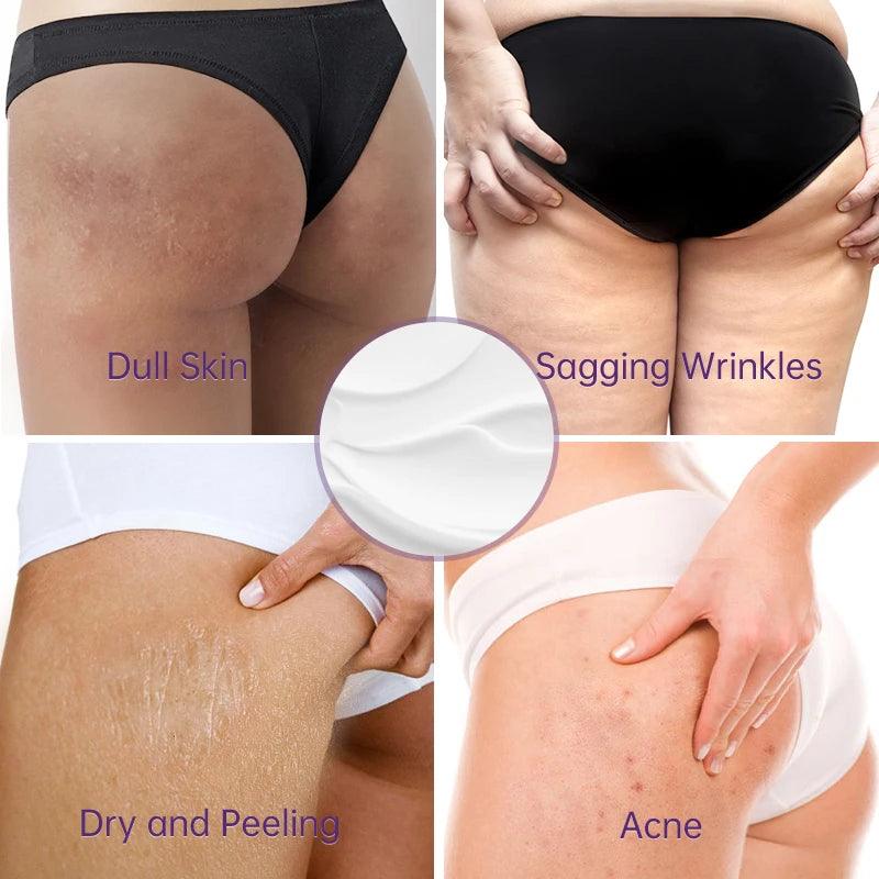 Acne Clearing Cream for Smooth and Radiant Buttocks and Thighs  ourlum.com   