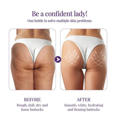 Clear Skin Acne Cream: Rapid Relief for Buttocks & Thighs