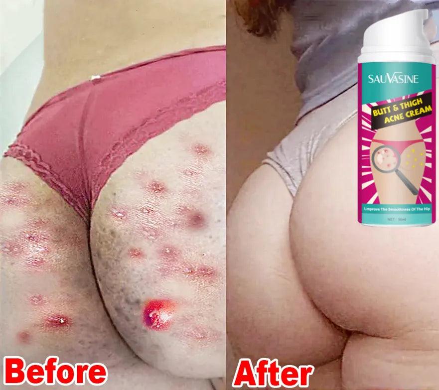 Booty Bliss Acne Eraser Cream - Say Goodbye to Butt Breakouts and Dark Spots  ourlum.com   