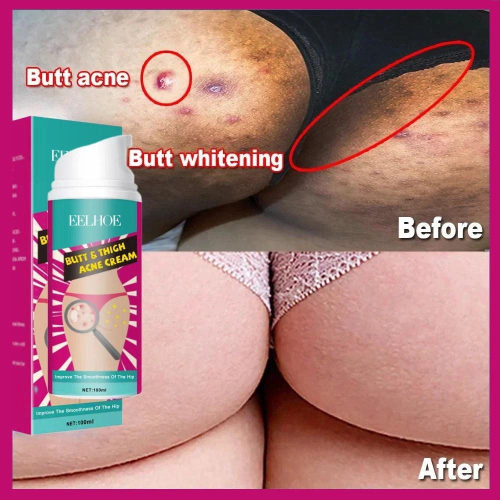 Butt Blemish Banisher: Clearing Cream for Smooth Skin & Brightening  ourlum.com   