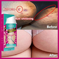 Butt Acne Clearing Cream: Brighten, Smooth, Combat Pimples & Dark Spots
