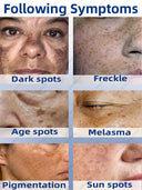 Advanced Spot Correcting Cream: Target Freckles, Melasma, and Age Spots  ourlum.com   