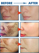 Advanced Spot Correcting Cream: Target Freckles, Melasma, and Age Spots  ourlum.com   