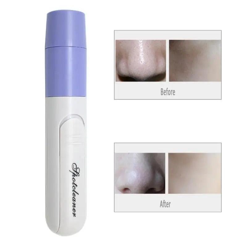 Portable Facial Pore Cleansing Beauty Device for Blackhead and Acne Removal  ourlum.com   