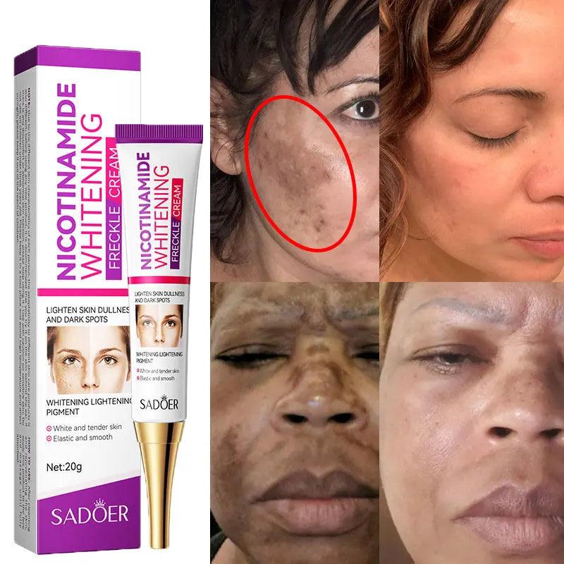 Radiant Skin Whitening Cream - Dark Spot & Acne Mark Remover  ourlum.com   