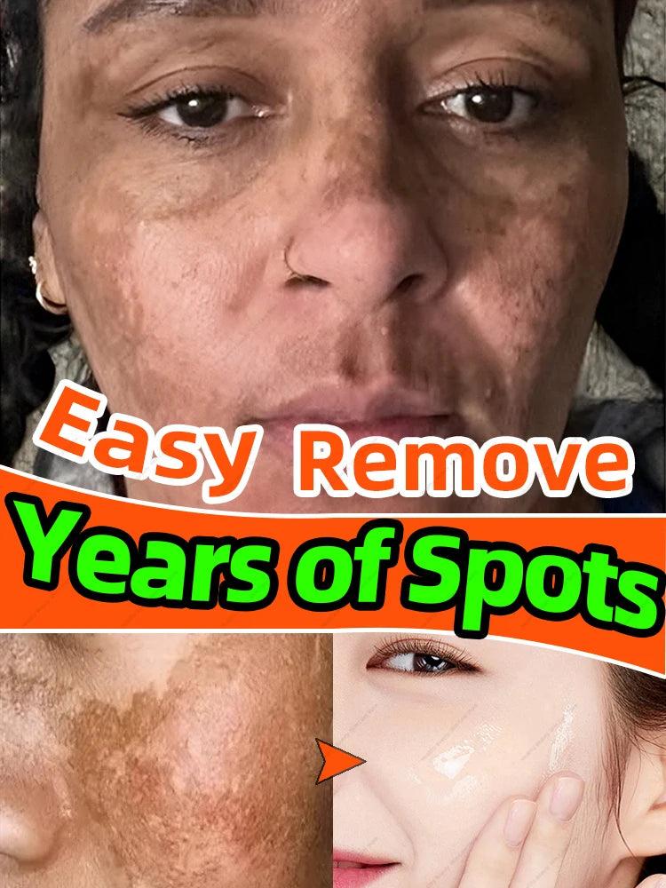 Spotless Complexion Dark Spot Remover Cream - Melasma & Freckle Remover  ourlum.com   