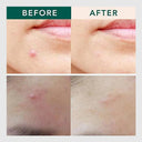 Advanced Hyaluronic Acid Microneedle Skin Therapy Patches  ourlum.com   