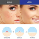 Acne Clear Microneedle Patches for Blemish-Free Skin  ourlum.com   