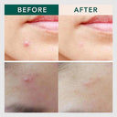 Acne Clear Microneedle Patches for Blemish-Free Skin  ourlum.com   