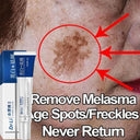 Radiant Skin Brightening Melasma Dark Spot Removal Cream