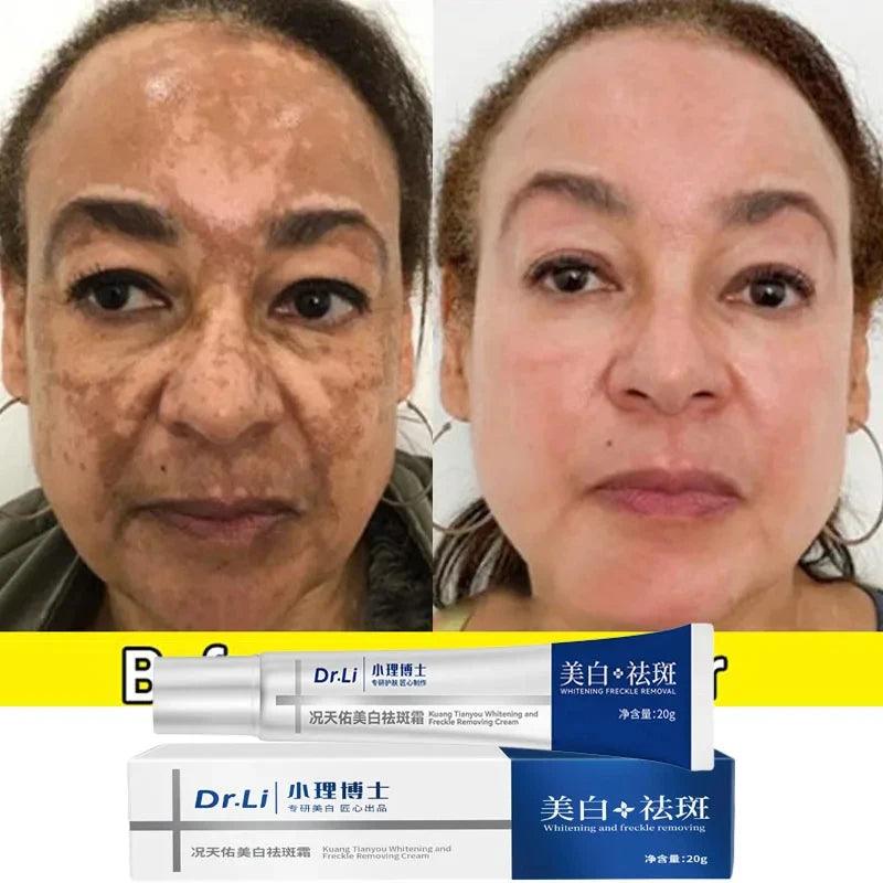 Skin Brightening Cream with Melasma and Dark Spot Removal, Anti-Pigmentation Formula for Youthful Radiance  ourlum.com   