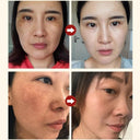 Skin Brightening Cream with Melasma and Dark Spot Removal, Anti-Pigmentation Formula for Youthful Radiance  ourlum.com   